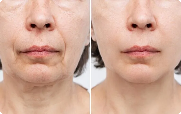 Before and after — injectables result 1