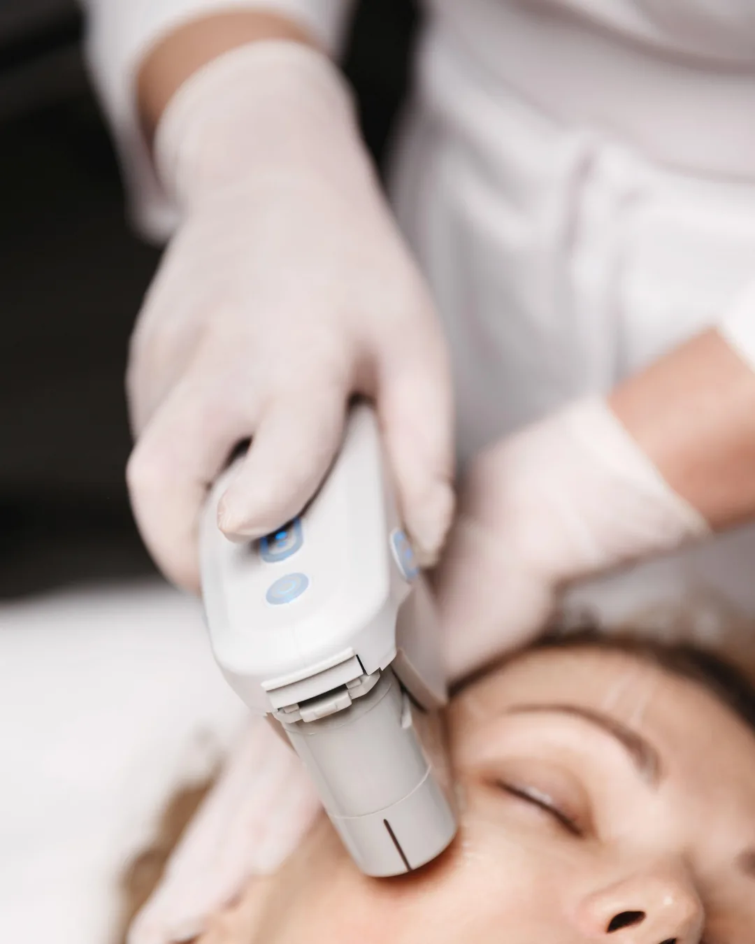 HIFU Skin Lifting