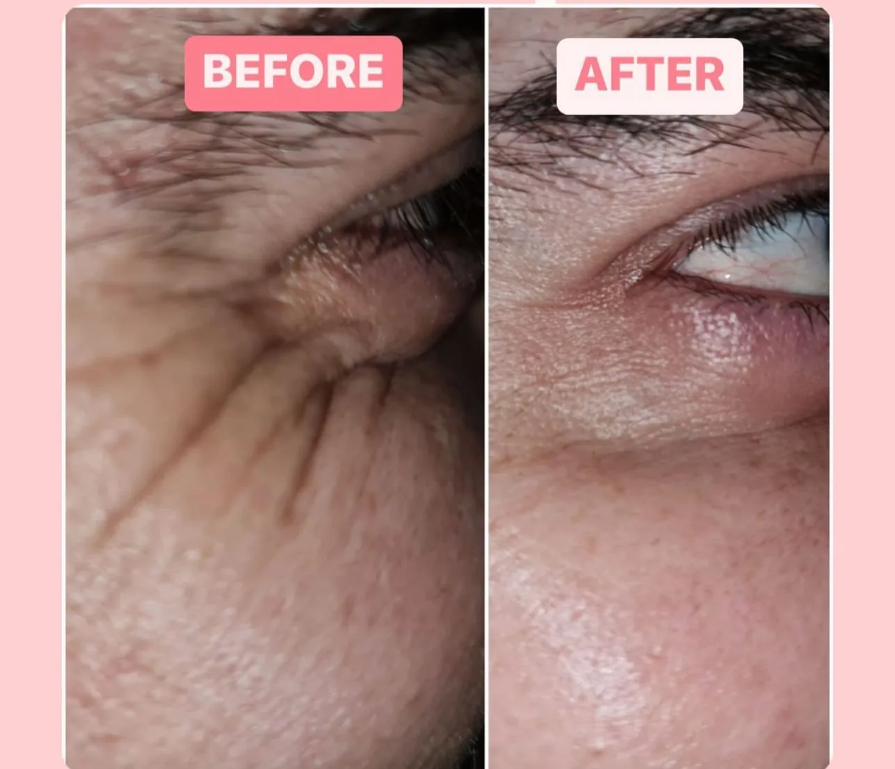 Crow's feet & fine lines (Around the eyes) — before and after at Derma Bliss