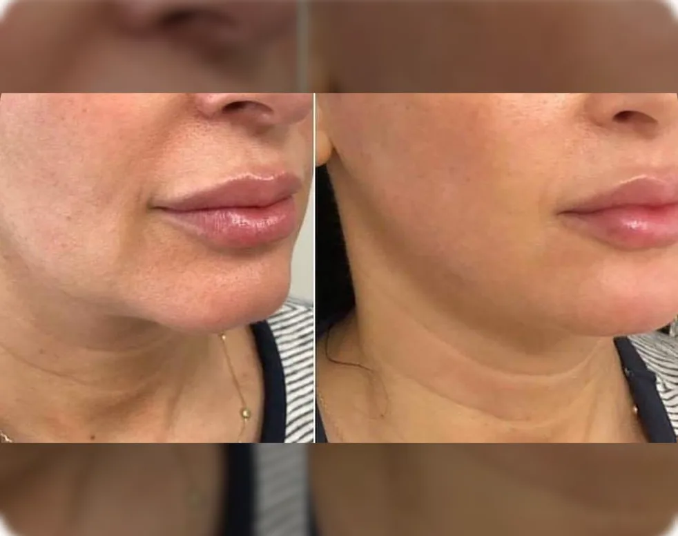 Jawline & neck definition (Lower face) — before and after at Derma Bliss