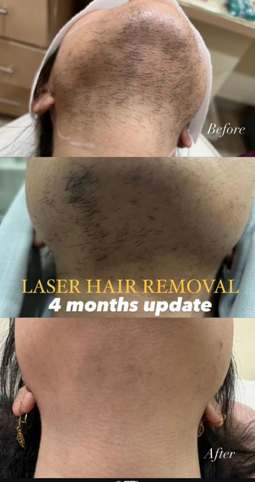 Laser hair removal (Neck · 4 months) — before and after at Derma Bliss