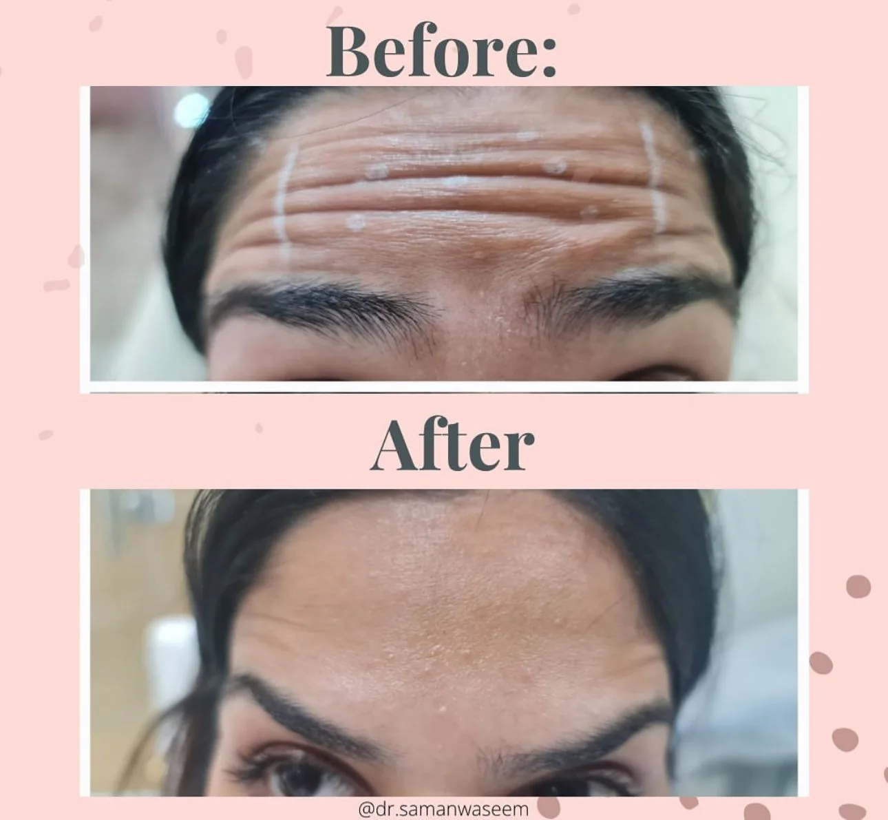 Forehead lines (Upper face) — before and after at Derma Bliss