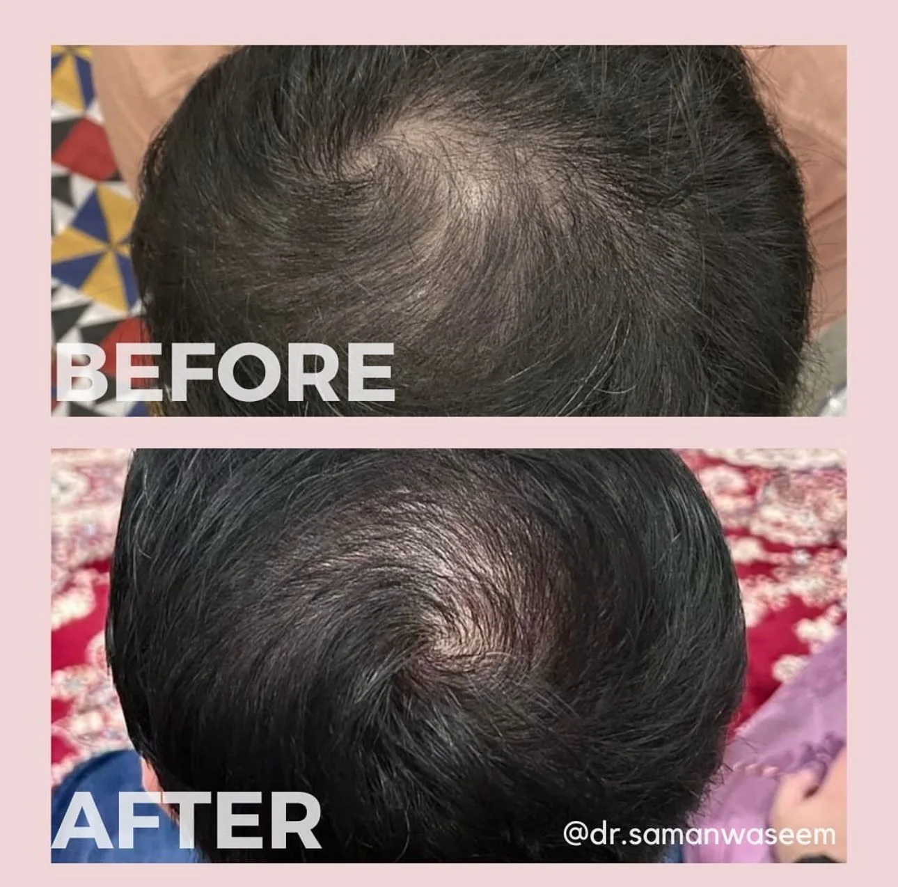 Hair density (Crown & scalp) — before and after at Derma Bliss