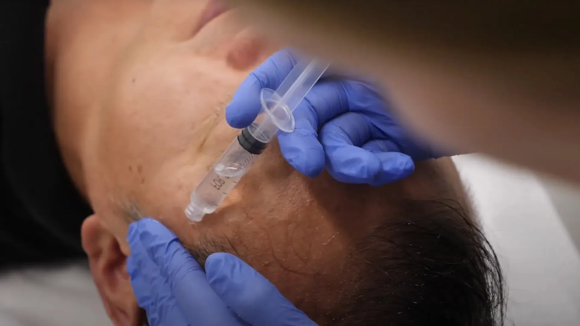 Acne Scar Treatment