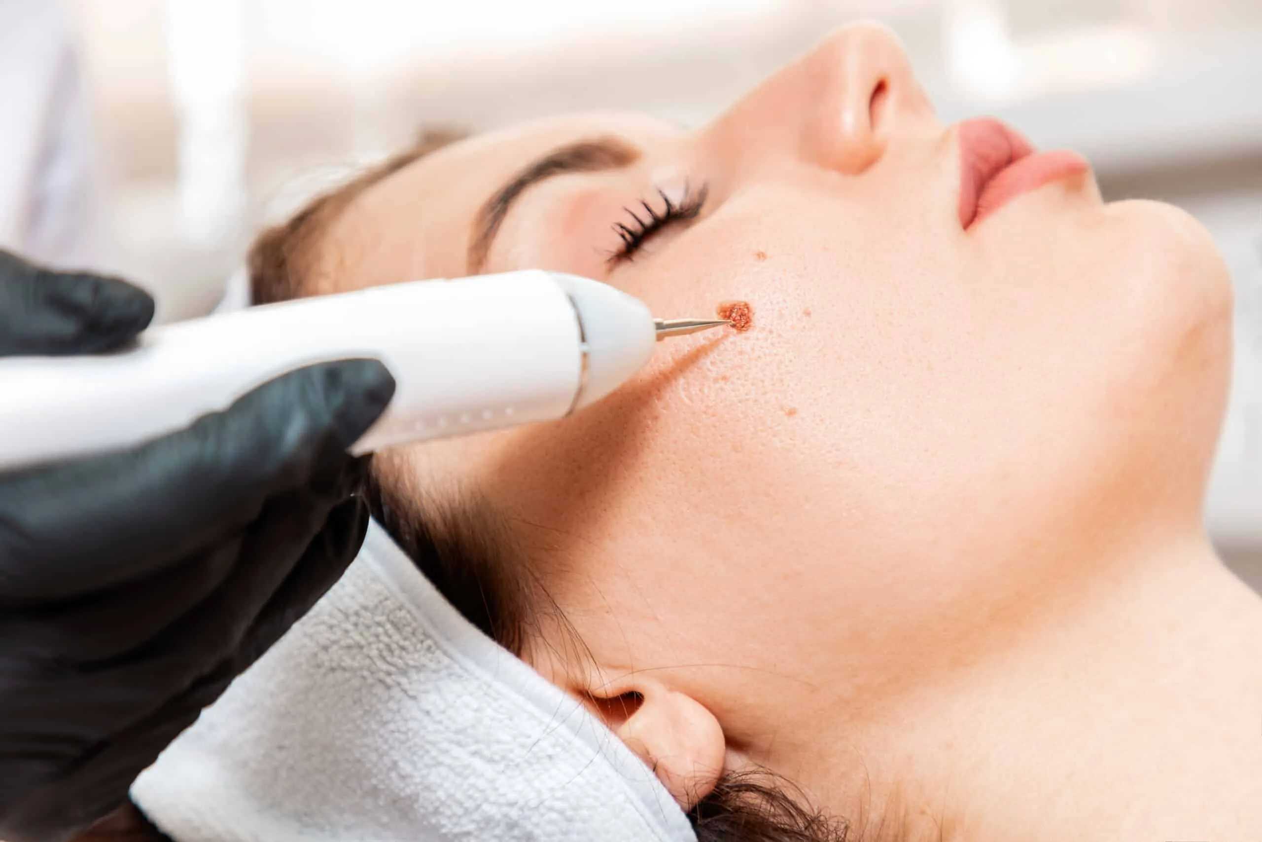 Freckle & Sun-Spot Removal