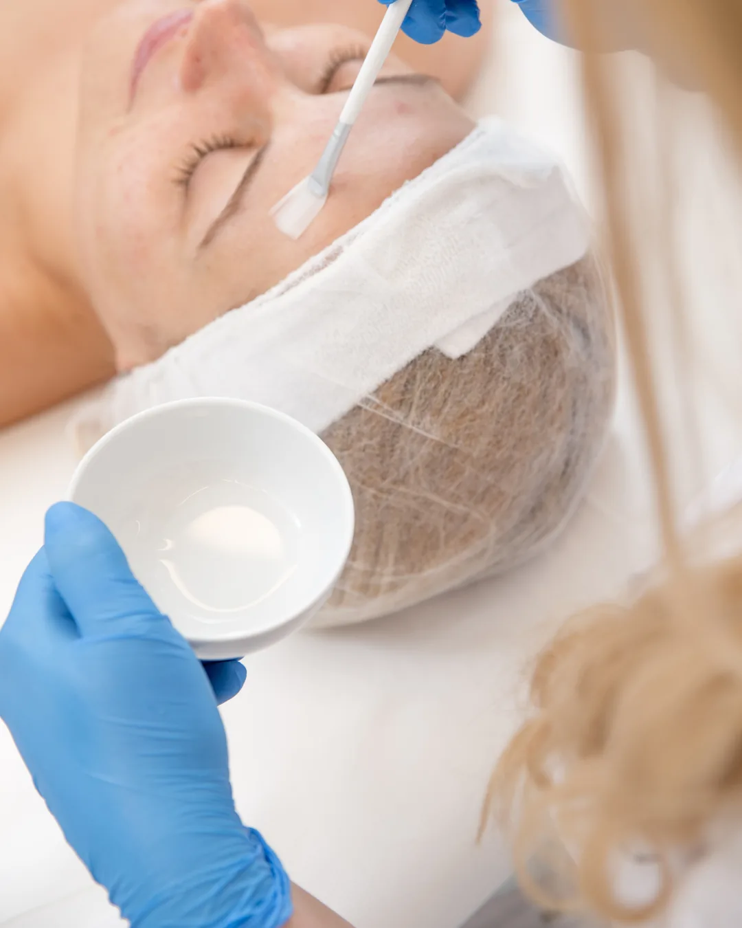 Chemical Peels