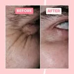 Botox