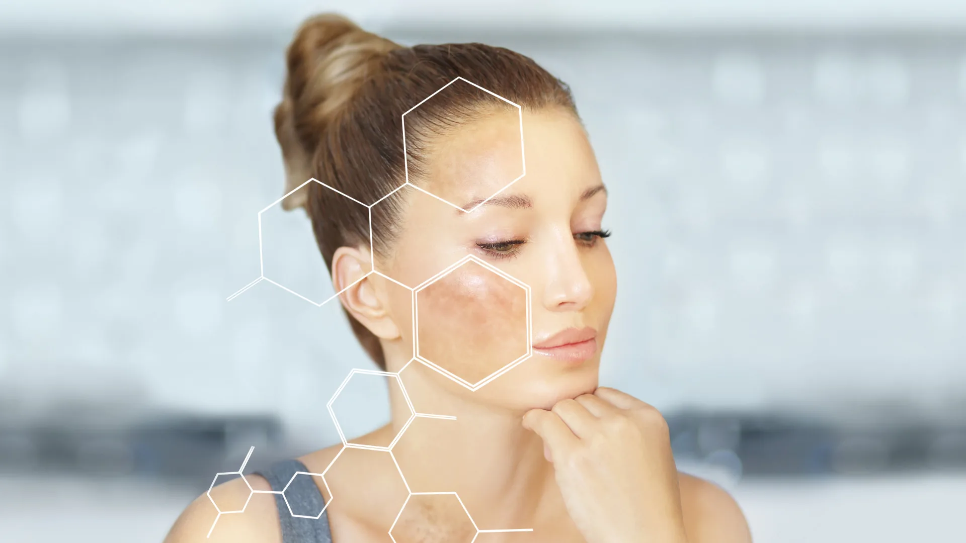 Melasma & Hyperpigmentation