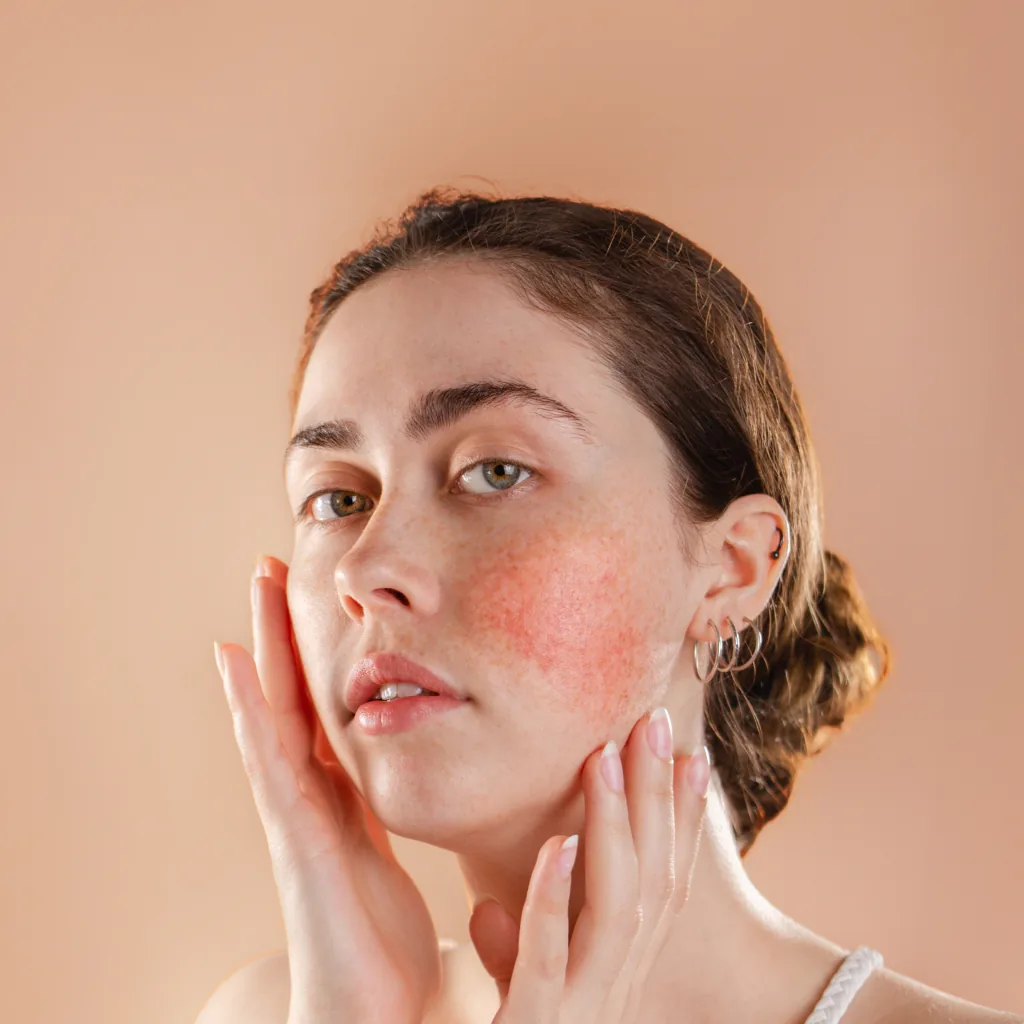 Rosacea Treatment