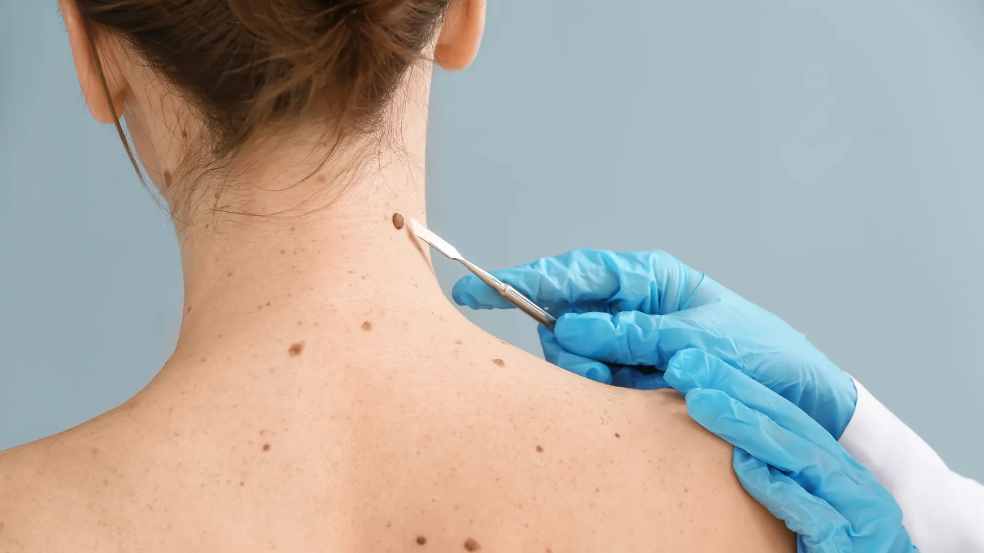 Mole & Skin Tag Removal