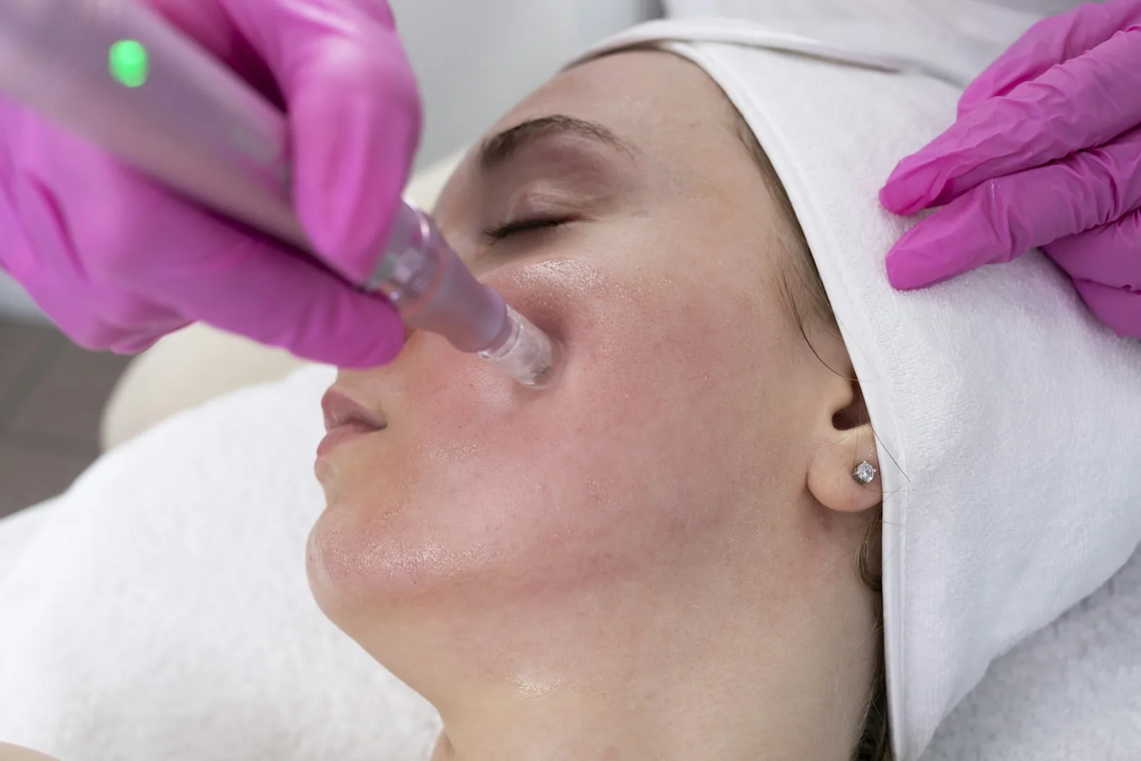 Dermapen Microneedling